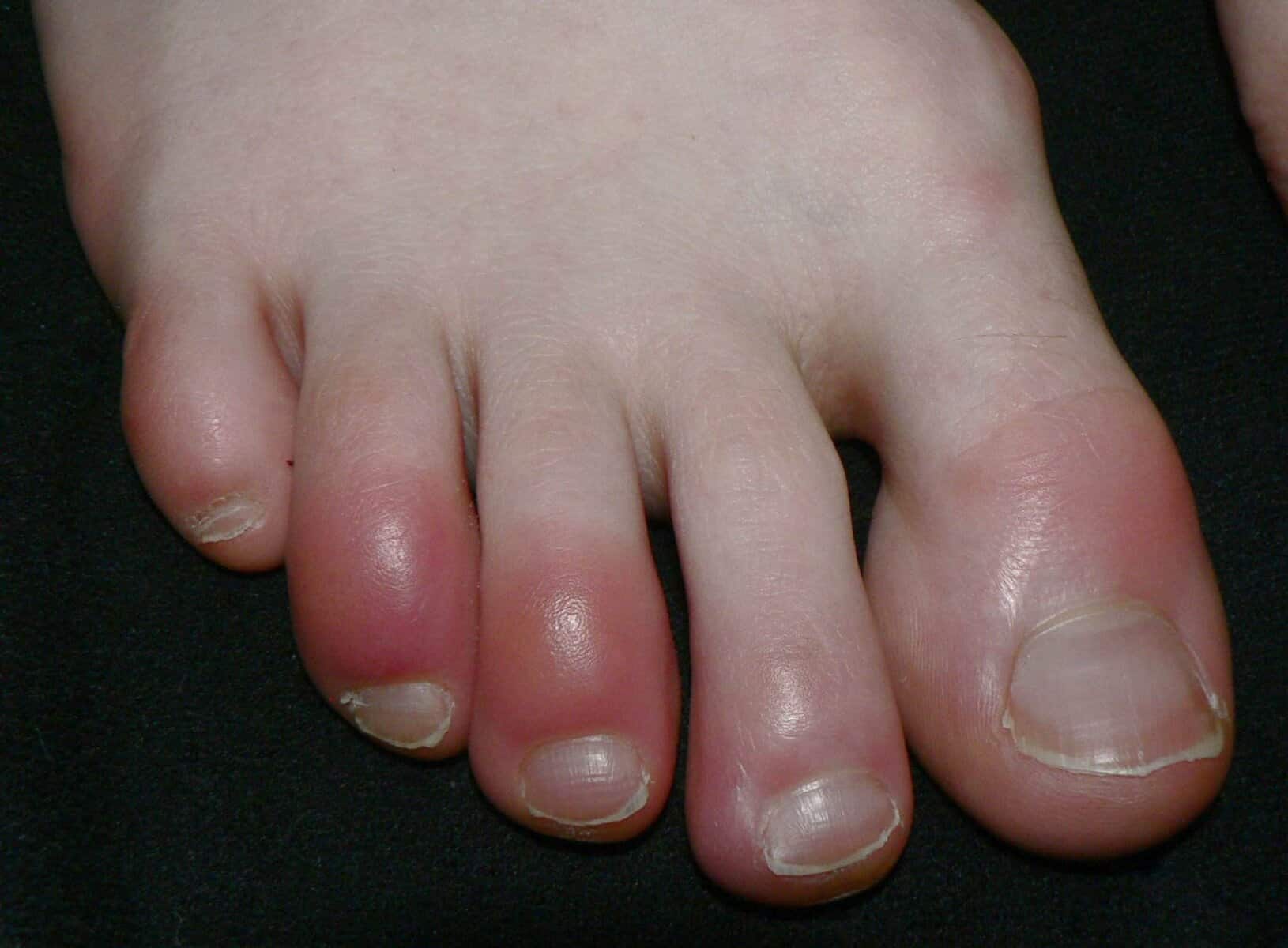 Trekking Tips 125 chilblains